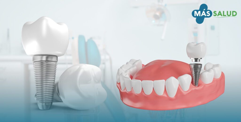 Dental-implants