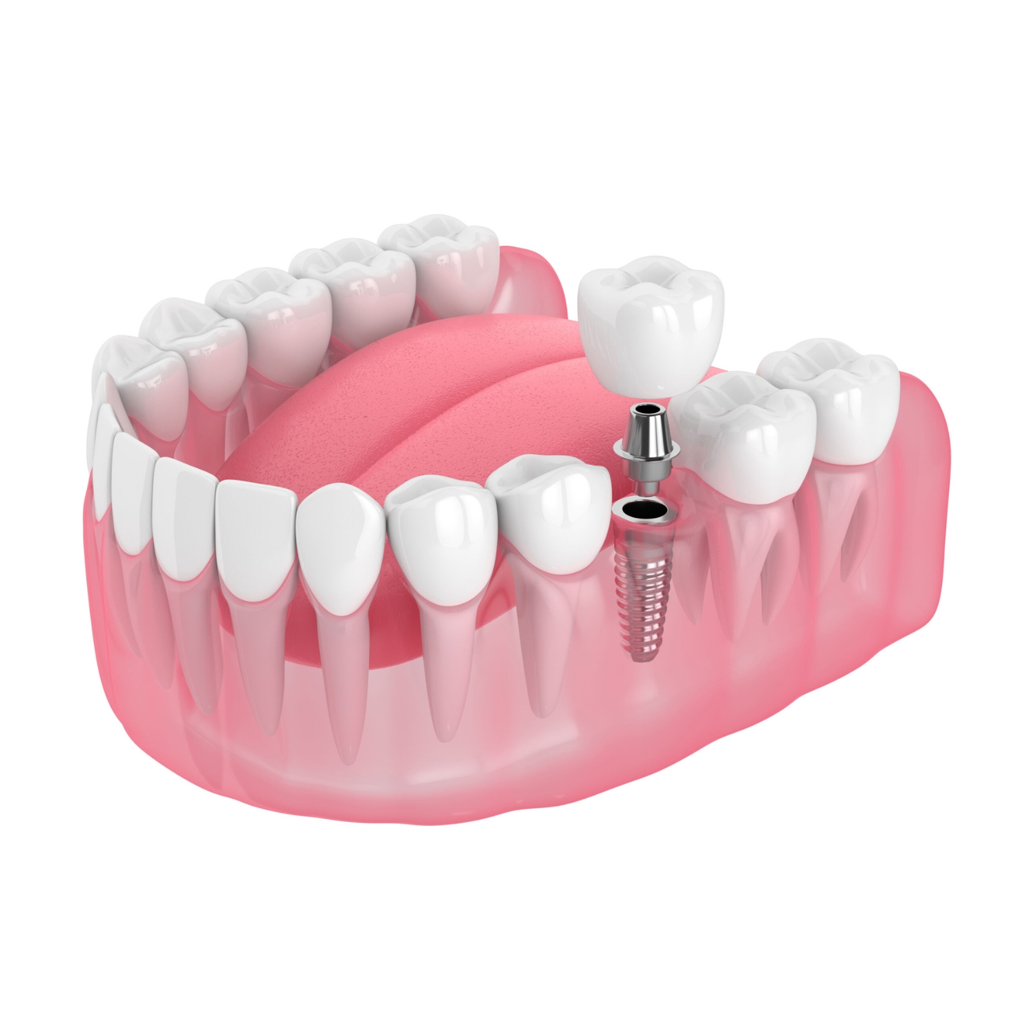 Single-tooth-implant